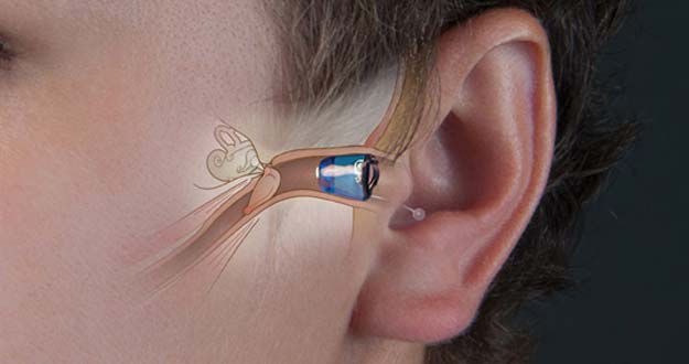 ¿Por qué me duele el oído con el molde del audífono? Causas y soluciones rápidas